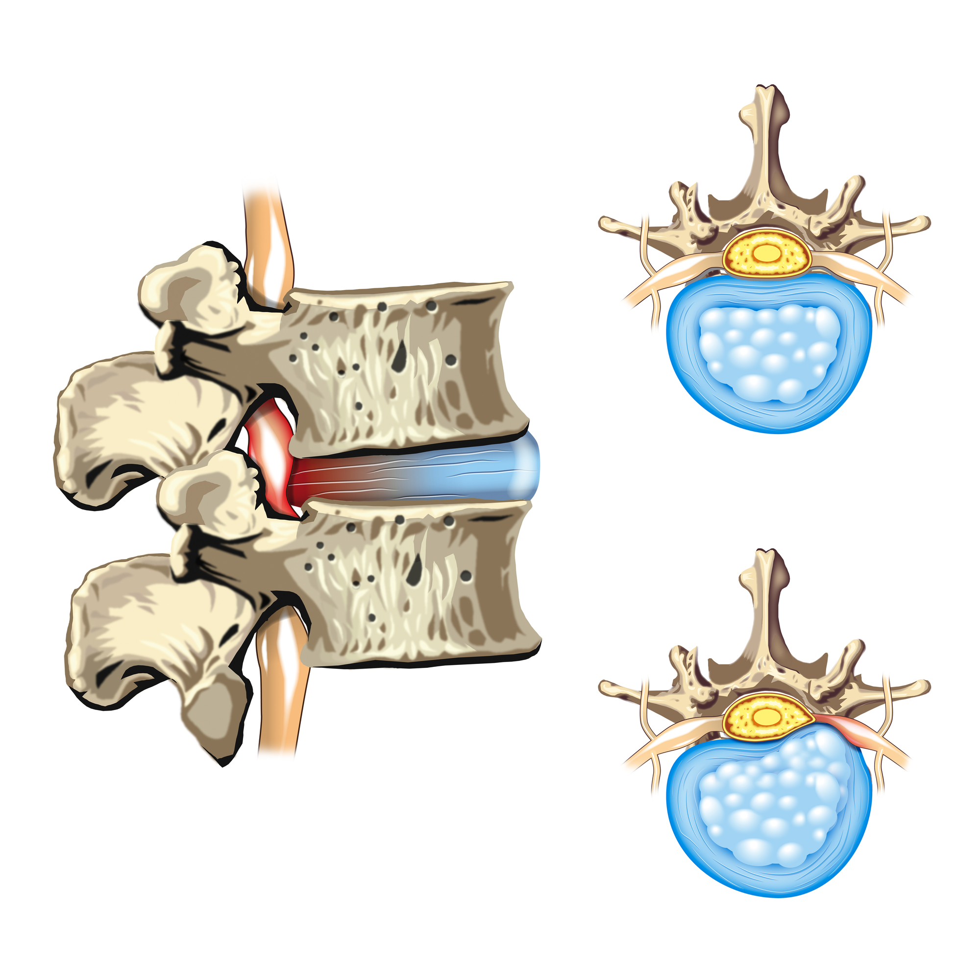 Do Bulging Discs Heal? Yes...Three Ways to Maximize Healing Potential