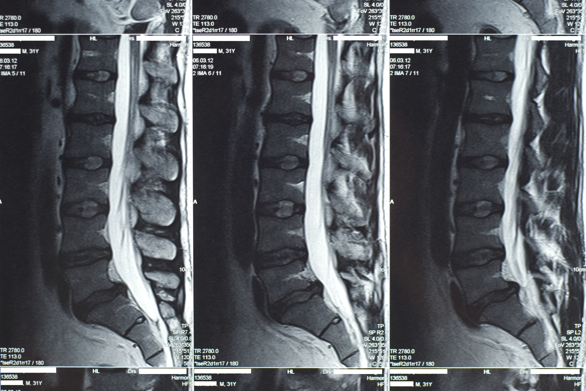 can a herniated disc heal on its own