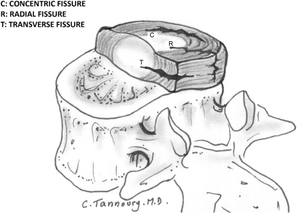 annular fissure types 