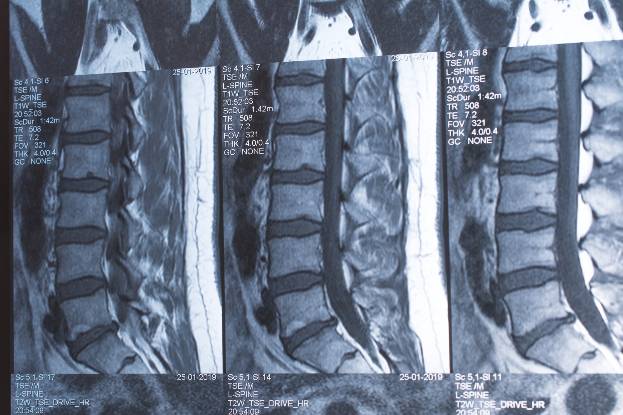 Your Lumbar MRI…Does It Matter