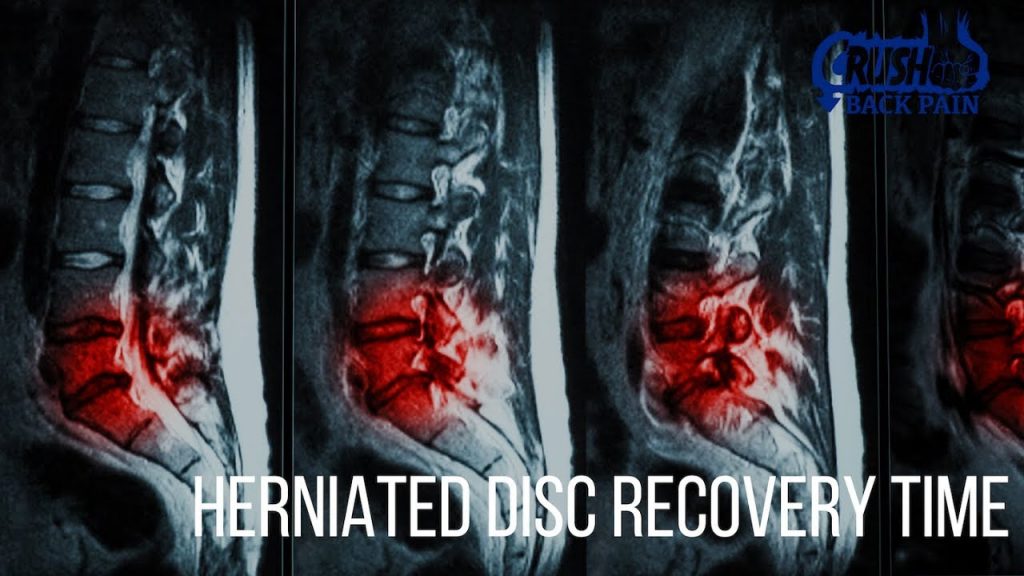 herniated-disc-recovery-time-crush-back-pain