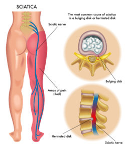 exercises for sciatica leg pain