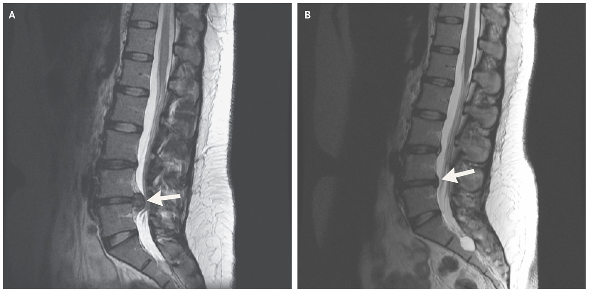 safe exercises for bulging disc