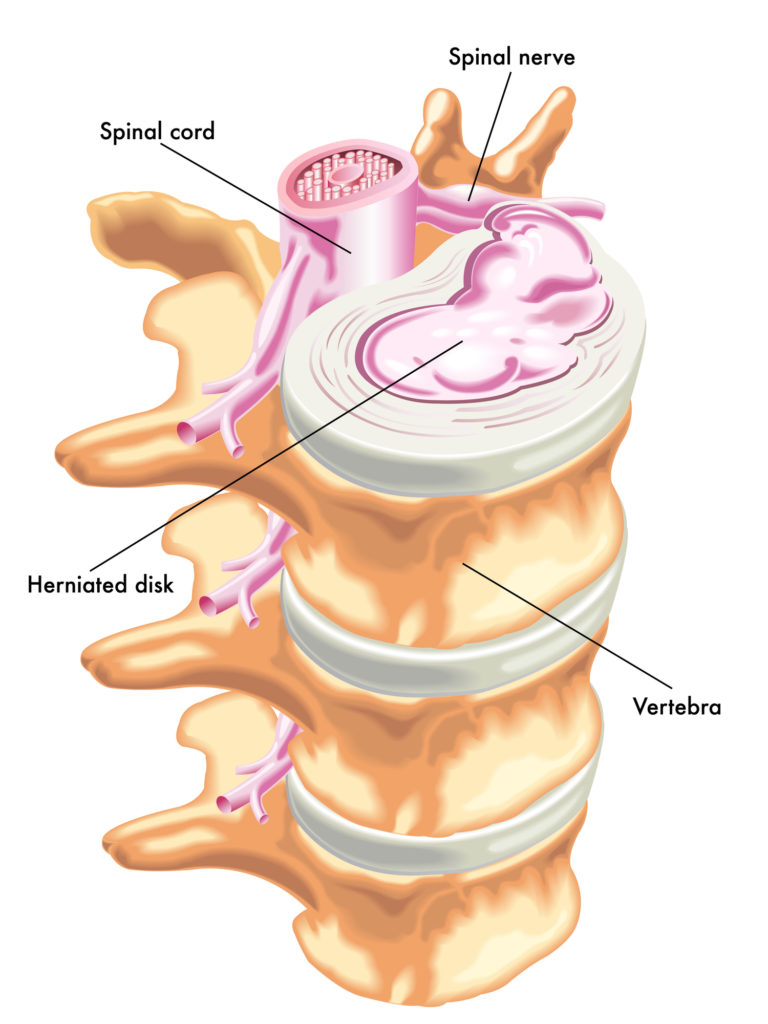 How to Heal a Herniated Disc Naturally - Crush Back Pain
