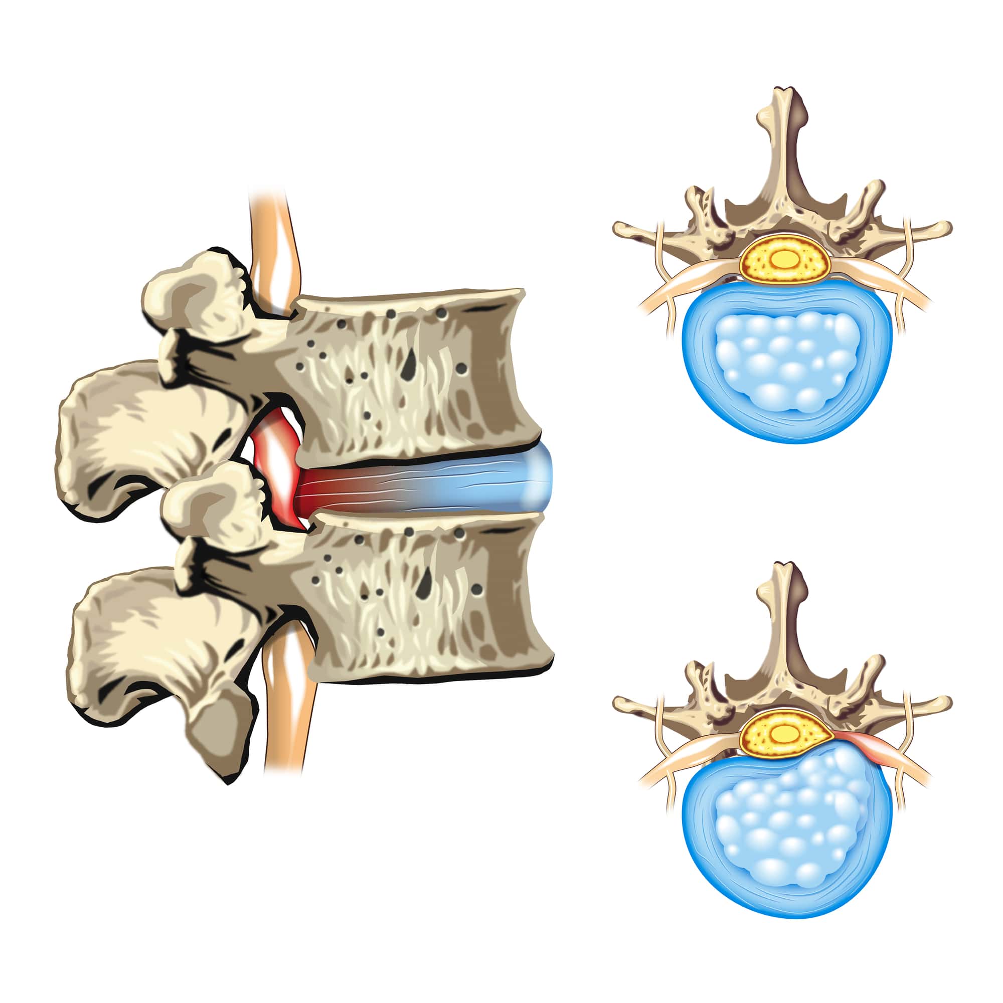 Do Bulging Discs Heal Yes…Three Ways to Maximize Healing Potential